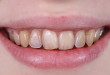 Cách phòng ngừa và điều trị mặt răng mòn