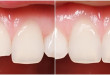 Mách bạn 3 cách bảo vệ răng cửa bị mẻ nhanh và hiệu quả nhất
