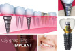Những điều cần chú ý khi trồng răng implant