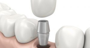 Trồng răng Implant có đau không? XEM NGAY TẠI ĐÂY 