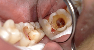 Bị sâu răng: cách chữa giảm đau răng hiệu quả sau một ngày sử dụng