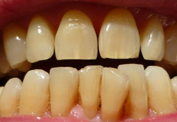 5 Nguyên nhân răng bị ố vàng nhiều người thường gặp phải