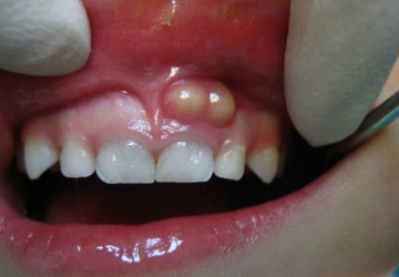 Viêm nướu răng ở trẻ em bệnh cần đề phòng