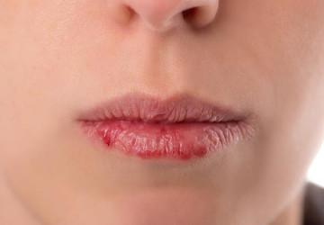 Bệnh lở miệng – nguyên nhân bệnh lở miệng do đâu và cách chữa?
