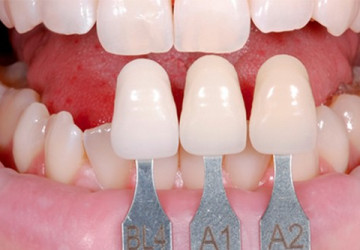 Xem ngay để biết có nên bọc mão răng sứ và quy trình bọc như thế nào?