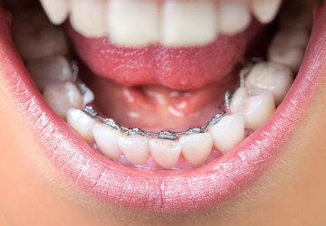 Niềng răng mất bao lâu mới hoàn thiện? – BS nha khoa