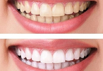 So sánh 2 phương pháp tẩy trắng răng và lấy cao răng